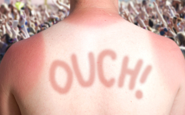 guy with sunburnt back